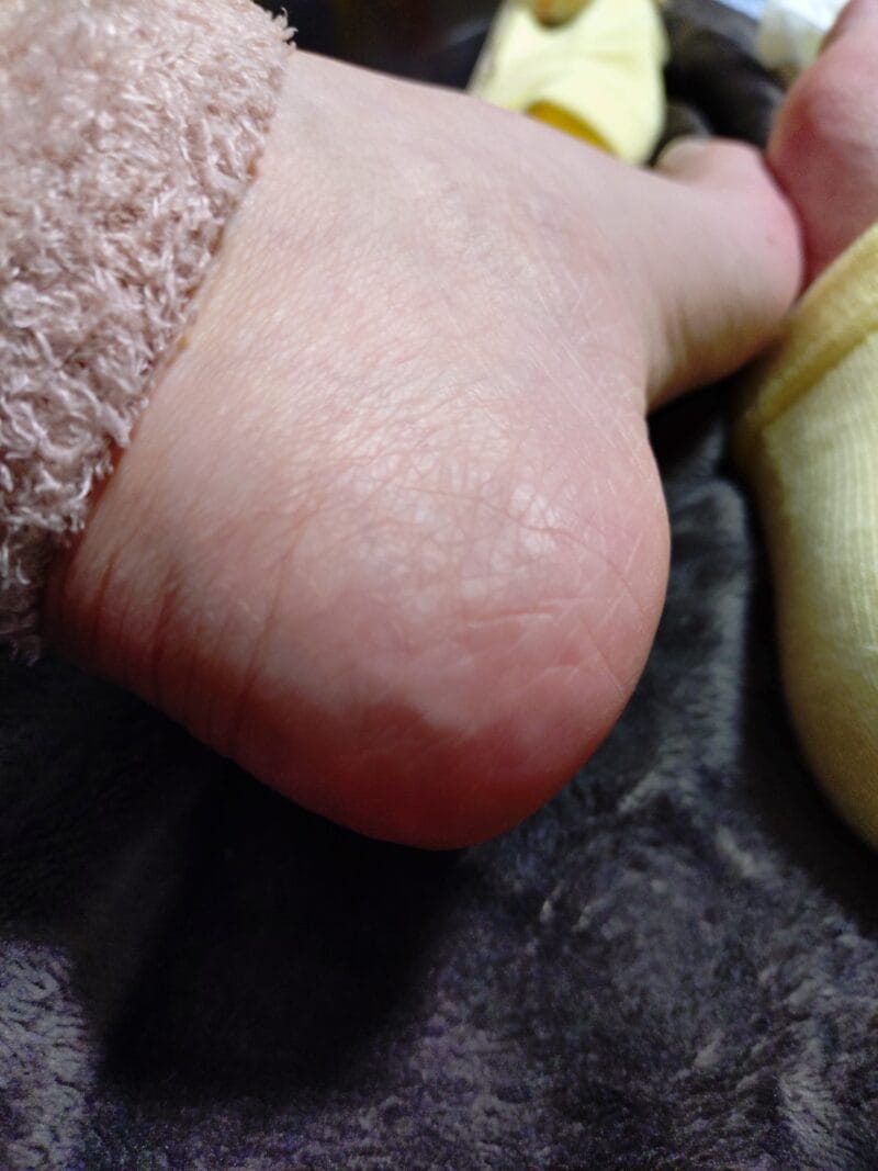 かかとの写真。ガサガサがなくなっている。